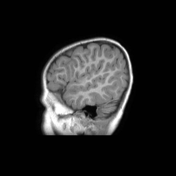 File:Cochlear nerve aplasia - unilateral (Radiopaedia 87910-104413 Sagittal T1 40).jpg