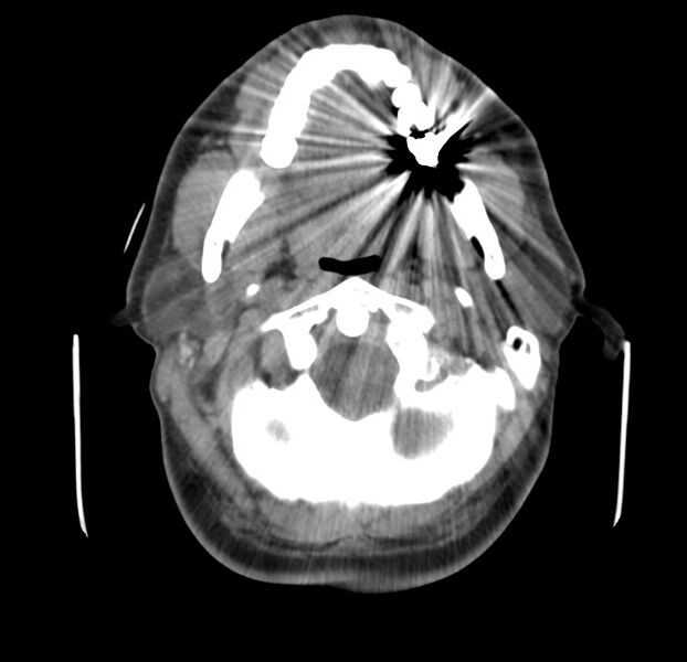 File:Colloid cyst of thyroid (Radiopaedia 22897-22923 Axial non-contrast 13).jpg