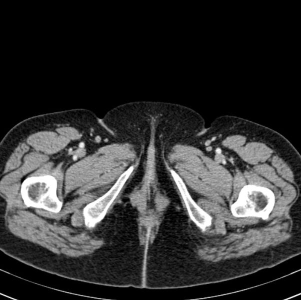 File:Colon carcinoma with hepatic metastases (Radiopaedia 29477-29961 A 127).jpg