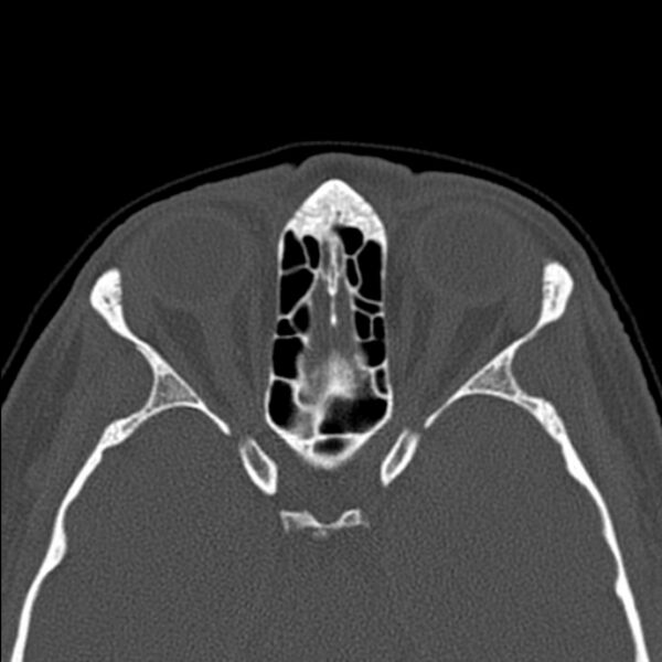 File:Nasal septal perforation (Radiopaedia 25030-25289 Axial bone window 46).jpg