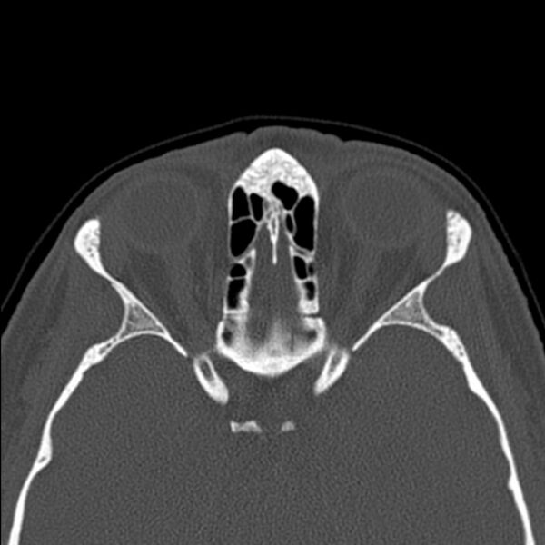File:Nasal septal perforation (Radiopaedia 25030-25289 Axial bone window 47).jpg