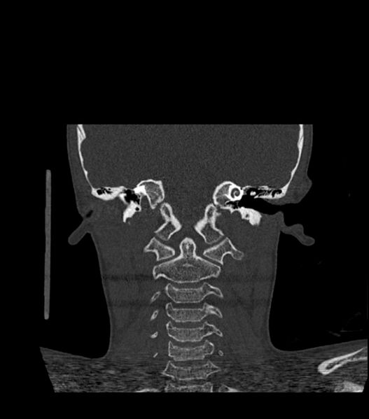 File:Nasoorbitoethmoid fracture (Radiopaedia 90044-107205 Coronal bone window 101).jpg