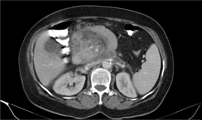 File:Necrotizing pancreatitis (Radiopaedia 20595-20495 A 14).jpg