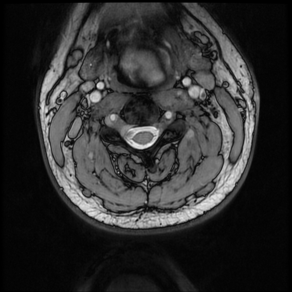 File:Neurofibromatosis type 2 (Radiopaedia 44936-48837 Axial Gradient Echo 32).png