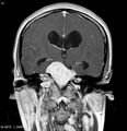 Neurofibromatosis type 2 - cranial and spinal involvement (Radiopaedia 5351-7111 Coronal T1 C+ 6).jpg