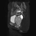 Non-puerperal uterine inversion (Radiopaedia 78343-90983 Sagittal T2 fat sat 16).jpg