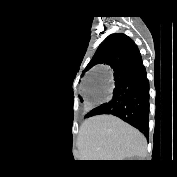 File:Non hodgkin lymphoma of the mediastinum (Radiopaedia 20814-20729 D 16).jpg