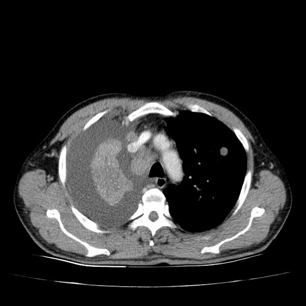 File:Non small-cell lung cancer (Radiopaedia 24467-24769 C+ delayed 19).jpg