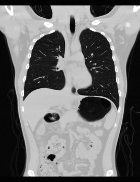 File:Normal CT virtual gastroscopy (Radiopaedia 29960-30501 F 9).jpg