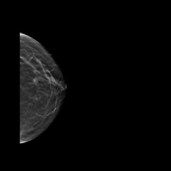 File:Normal breast mammography (tomosynthesis) and ultrasound (Radiopaedia 65325-74353 LCC Tomo 20).jpeg