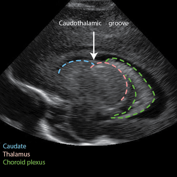 File:Normal caudothalamic groove (Radiopaedia 8353-9194 Annotated 1).png