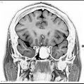 Normal coronal brain (Radiopaedia 6676-7910 B 13).jpg