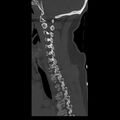Occipital condyle fracture (Radiopaedia 31755-32691 Sagittal bone window 13).jpg