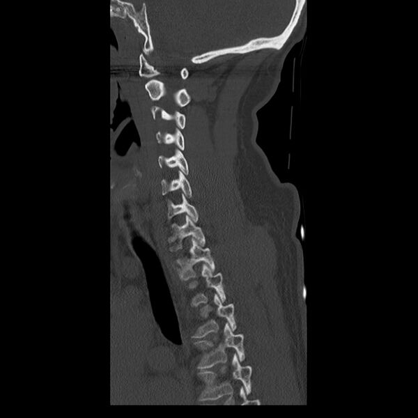 File:Occipital condyle fracture (Radiopaedia 31755-32691 Sagittal bone window 13).jpg