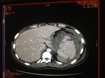 Image of abdomen shows ruptured spleen (and the perisplenic hematoma)