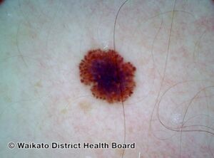 Superficial spreading melanoma, Breslow 0.4 mm, nonpolarised dermoscopy view (DermNet NZ superficial-spreading-melanoma-002-dnp).jpg