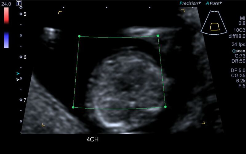 File:1st trimester nuchal-morphology ultrasound (Radiopaedia 44706-48477 Heart views cine with colour 36).jpg