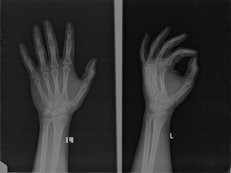 File:3rd metacarpal shaft fracture (Radiopaedia 47786-52511 Frontal and oblique 1).jpg