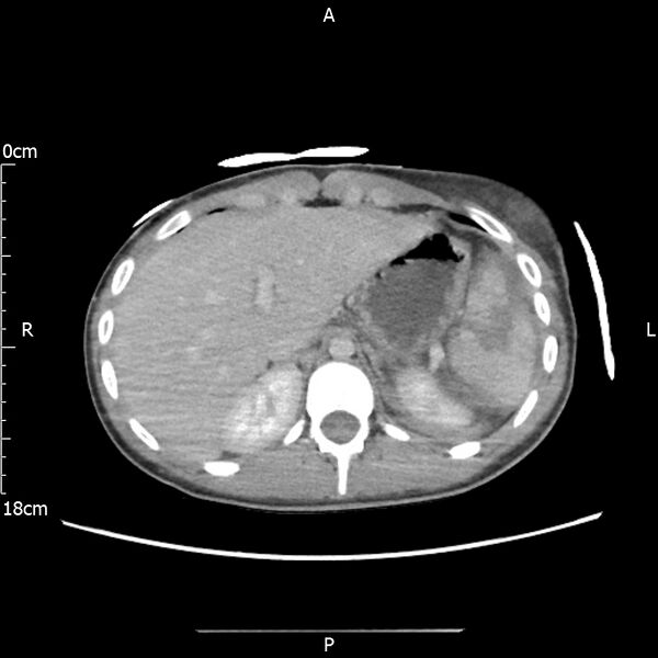 File:AAST grade IV kidney injury with CEUS follow-up (Radiopaedia 72353-82877 Axial C+ portal venous phase 14).jpg