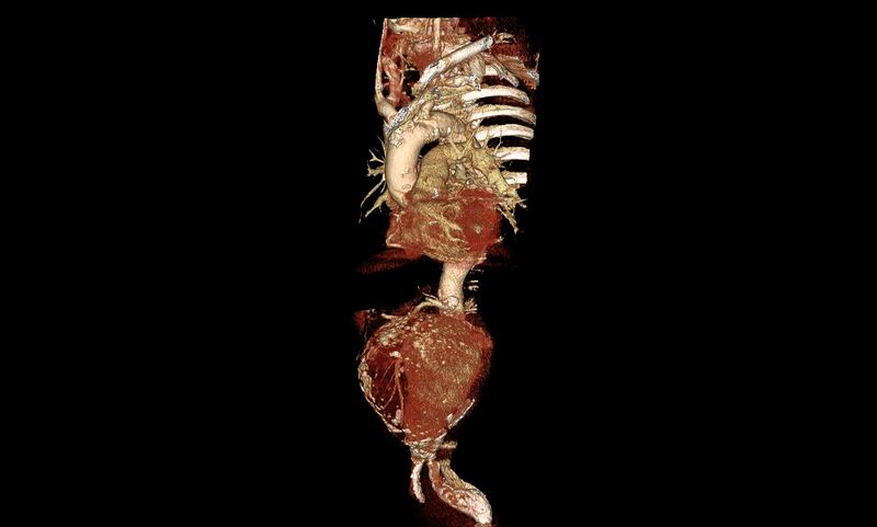 File:Abdominal aortic aneurysm- extremely large, ruptured (Radiopaedia 19882-19921 3D 4).jpg
