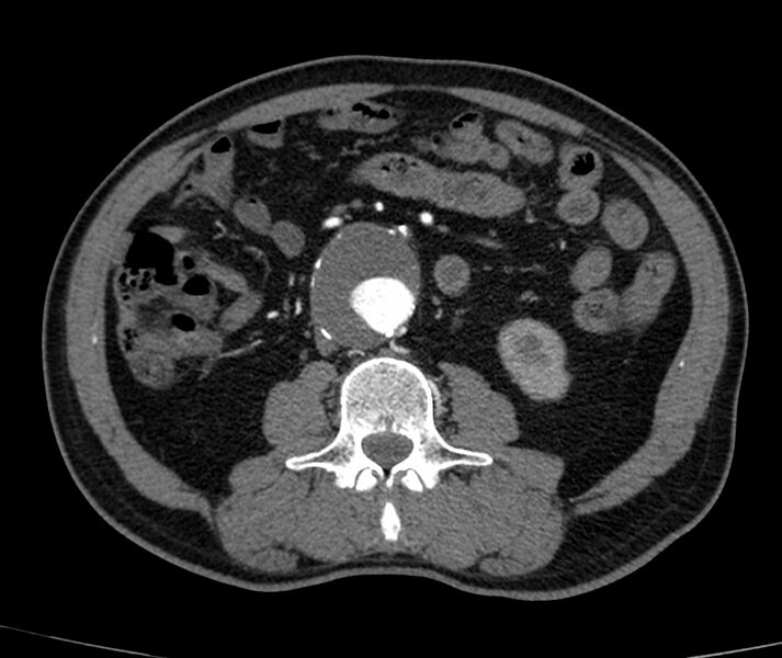 File:Abdominal aortic aneurysm (Radiopaedia 22421-22458 C+ arterial phase 46).jpg