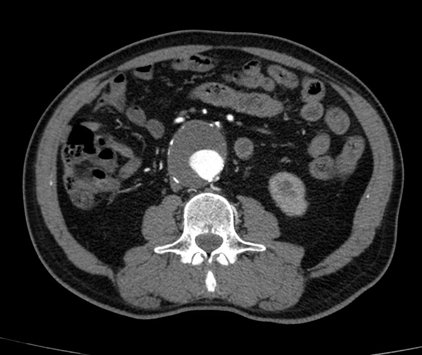 Abdominal aortic aneurysm (Radiopaedia 22421-22458 C+ arterial phase 46).jpg