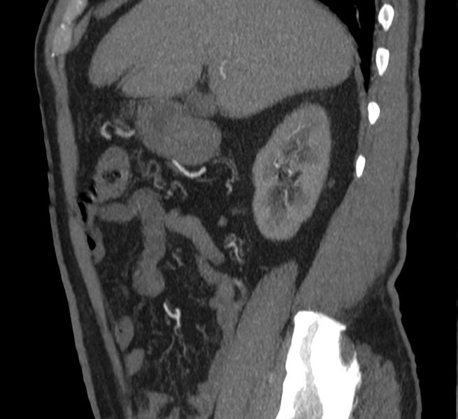 File:Abdominal aortic aneurysm (Radiopaedia 22421-22458 D 6).jpg