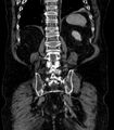 Abdominal aortic aneurysm (Radiopaedia 25855-26001 Coronal C+ arterial phase 63).jpg