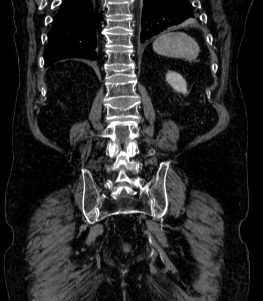 File:Abdominal aortic aneurysm (Radiopaedia 25855-26001 Coronal C+ arterial phase 63).jpg