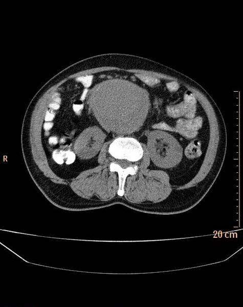 File:Abdominal aortic aneurysm (Radiopaedia 25985-26121 Axial non-contrast 11).jpg