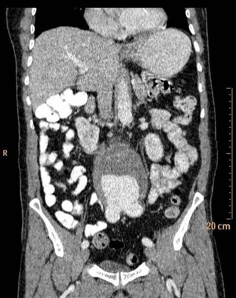 File:Abdominal aortic aneurysm (Radiopaedia 25985-26121 Coronal C+ arterial phase 17).jpg