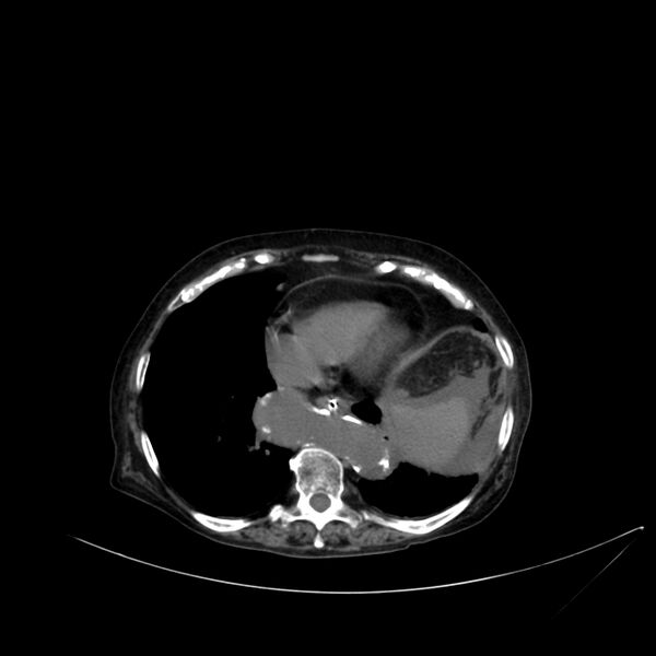 File:Abdominal aortic aneurysm - impending rupture (Radiopaedia 19233-19246 Axial non-contrast 17).jpg