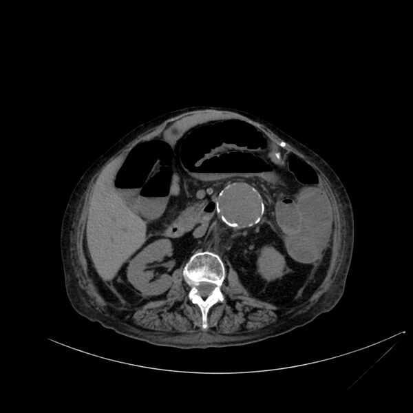 File:Abdominal aortic aneurysm - impending rupture (Radiopaedia 19233-19246 Axial non-contrast 58).jpg