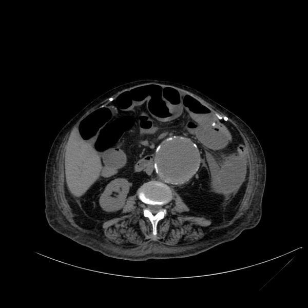 File:Abdominal aortic aneurysm - impending rupture (Radiopaedia 19233-19246 Axial non-contrast 66).jpg