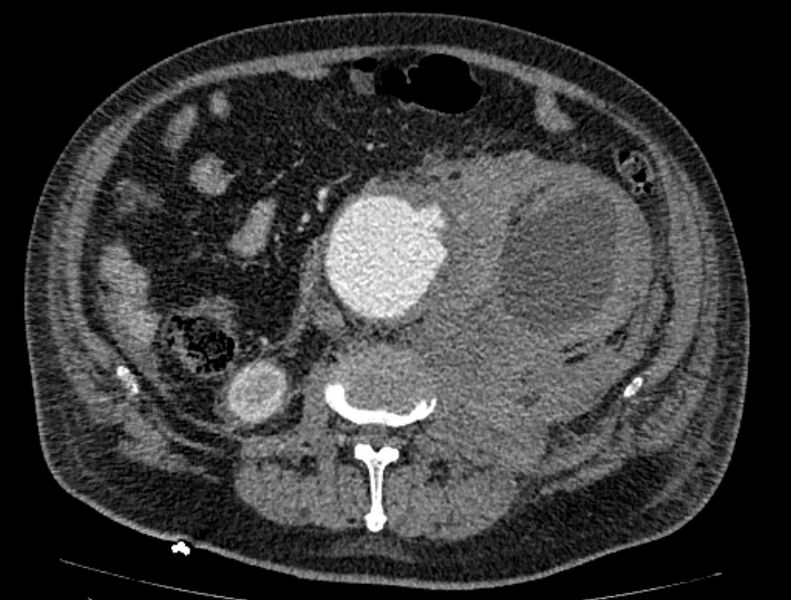 File:Abdominal aortic aneurysm rupture (Radiopaedia 54179-60362 Axial C+ portal venous phase 20).jpg