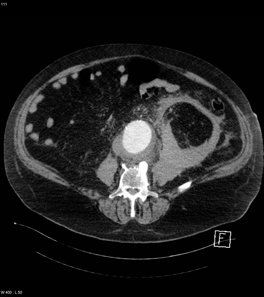 Abdominal aortic aneurysm with intramural hematoma then rupture (Radiopaedia 50278-55632 Axial C+ arterial phase 110).jpg