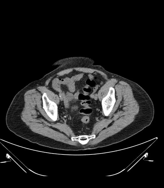 File:Abdominal aortic aneurysm with thrombus fissuration (Radiopaedia 46218-50618 Axial non-contrast 50).jpg