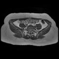 Abdominal wall endometriosis (Radiopaedia 83702-98847 Axial T1 1).jpg