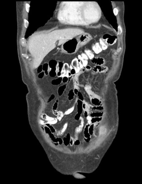 File:Abdominal wall metastasis from colorectal carcinoma (Radiopaedia 31016-31717 Coronal C+ portal venous phase 10).jpg