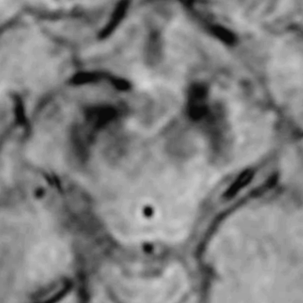 File:Absent swallow tail sign in Parkinson disease (Radiopaedia 31115).png
