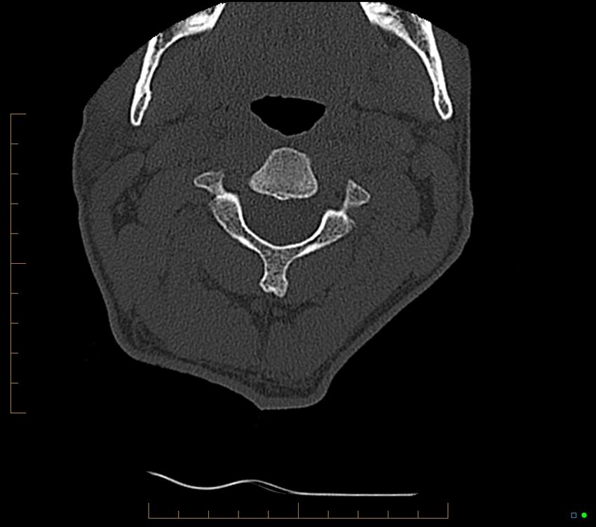 Accessory articulation of cervical transverse processes (Radiopaedia 82715-96933 Axial non-contrast 39).jpg