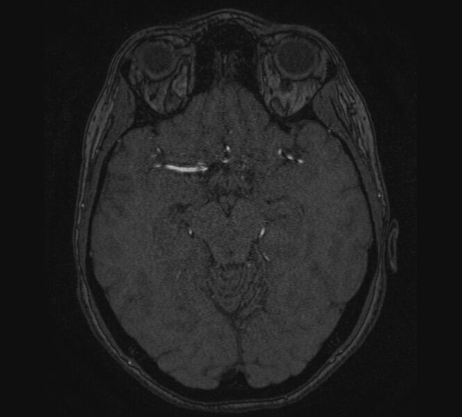 File:Accessory middle cerebral artery and ICA aneurysm (Radiopaedia 22656-22674 MRA 52).jpg