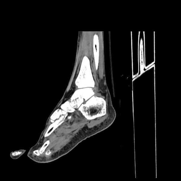 File:Accessory soleus muscle (Radiopaedia 61069-68943 C 18).jpg