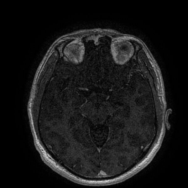 File:Acoustic schwannoma - intracanalicular (Radiopaedia 37247-39024 Axial T1 C+ 112).jpg
