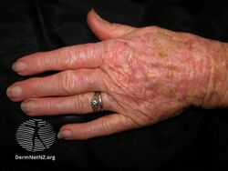 Actinic keratosis affecting a hand (DermNet NZ lesions-ak-hands-247).jpg