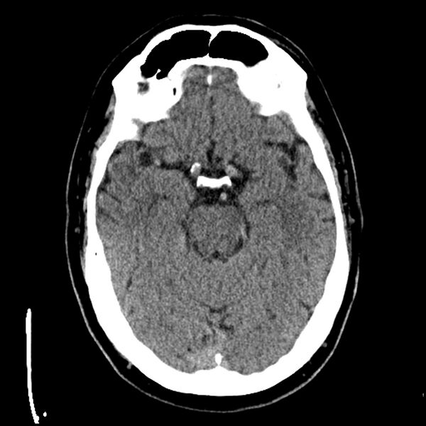 File:Acute A3 occlusion with ACA ischemic penumbra (CT perfusion) (Radiopaedia 72036-82525 Axial non-contrast 16).jpg