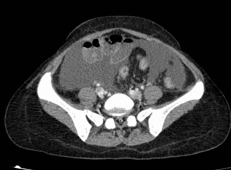 File:Acute Budd-Chiari syndrome (Radiopaedia 60858-68638 Axial C+ portal venous phase 216).jpg
