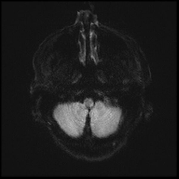 File:Acute P1 occlusion with PCA ischemia penumbra (CT perfusion) (Radiopaedia 72084-82590 Axial DWI 4).jpg