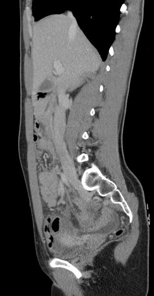File:Acute appendicitis (Radiopaedia 62608-70901 Sagittal C+ portal venous phase 31).jpg