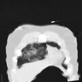 Acute aspiration pneumonitis (Radiopaedia 33605-34703 Coronal lung window 14).jpg